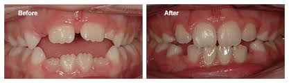 DrGorczyca's tweet photo. Open bites can usually be corrected in young children non-surgically if caught early. #openbite #openbites #orthodontics #orthodontist https://t.co/fLLhBri7X1