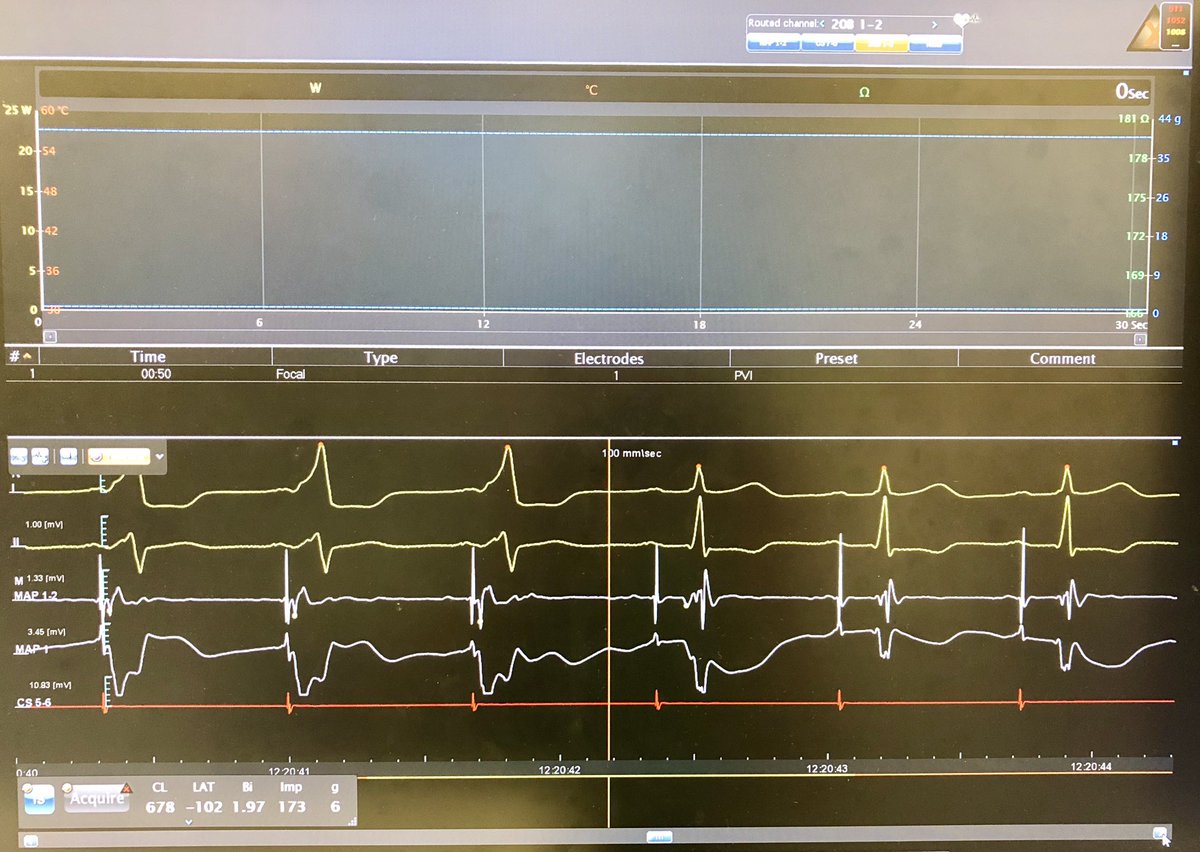 DRTomlinsonEP's tweet photo. #EPeeps What constitutes “clinically important” catheter motion?
Here, 1mm radius VISITAG delivered at site of bump block at AP earliest LAT following ~4mm motion posterior to anterior (with Agilis) gives perspective.
Q: What #RF_annotation settings permit such motion detection? https://t.co/2awFpRPd2X