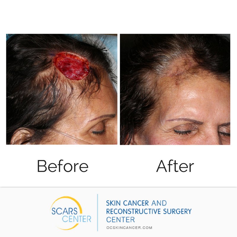 SCARSCenter's tweet image. GRAPHIC: The treatment options available to you vary by the type of #skincancer detected, the size and placement of it, and its overall development. For more information on available treatments call: (949) 719-1800
