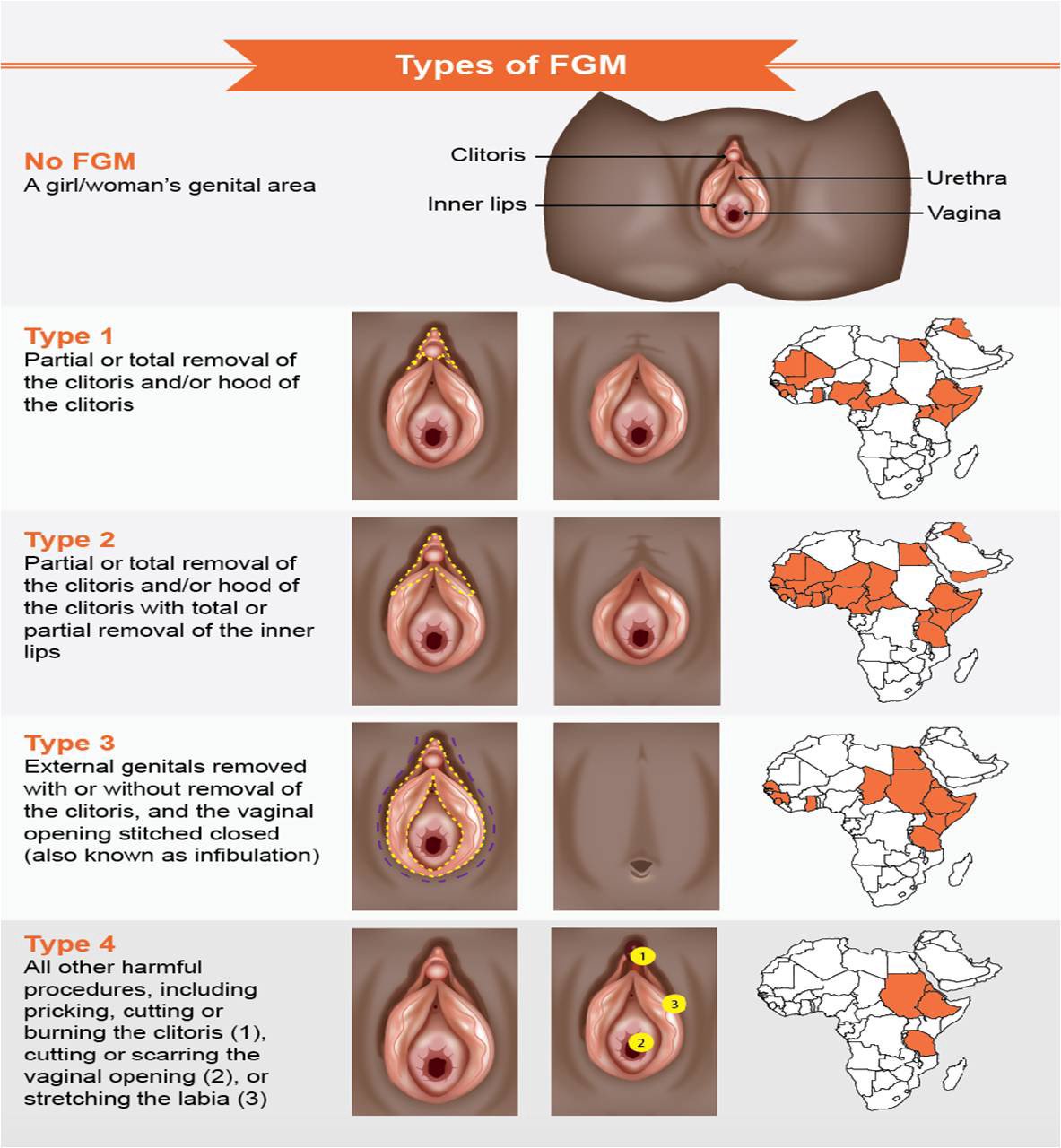 clitoris lips 1. What constitutes FGM/C: a. partial/total removal of clitoris b. Removal of the hood c. Complete removal of genitals d. Cutting and burning clitoris e.