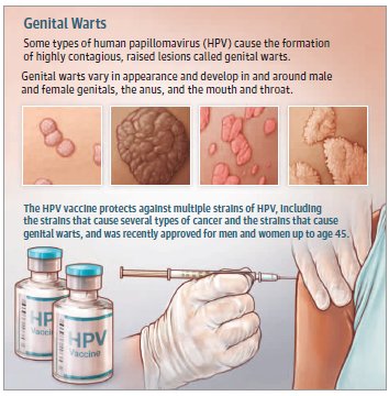 Hpv genital warts strain - Hpv strains genital warts, Condylomata (Genital Warts; HPV)