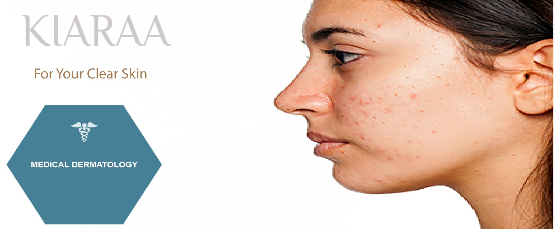 Kiaraaclinic on Twitter "Botex Dermel_Fillers_at_Trivandrum Dermel