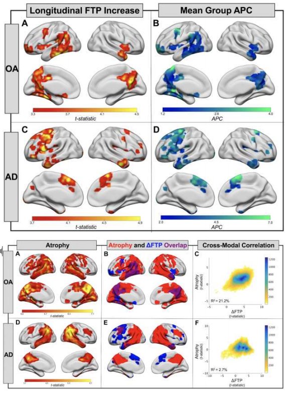 lots of great #dementia work in this issues of the annals - onlinelibrary.wiley.com/toc/15318249/2… 

my highlight:
onlinelibrary.wiley.com/doi/abs/10.100…
shows tau in 'normal' aging accompanied by 'normal' atrophy; whereas in AD it comes well before atrophy

@relajoie 

#Alzheimers  #neuroscience #PET #tau