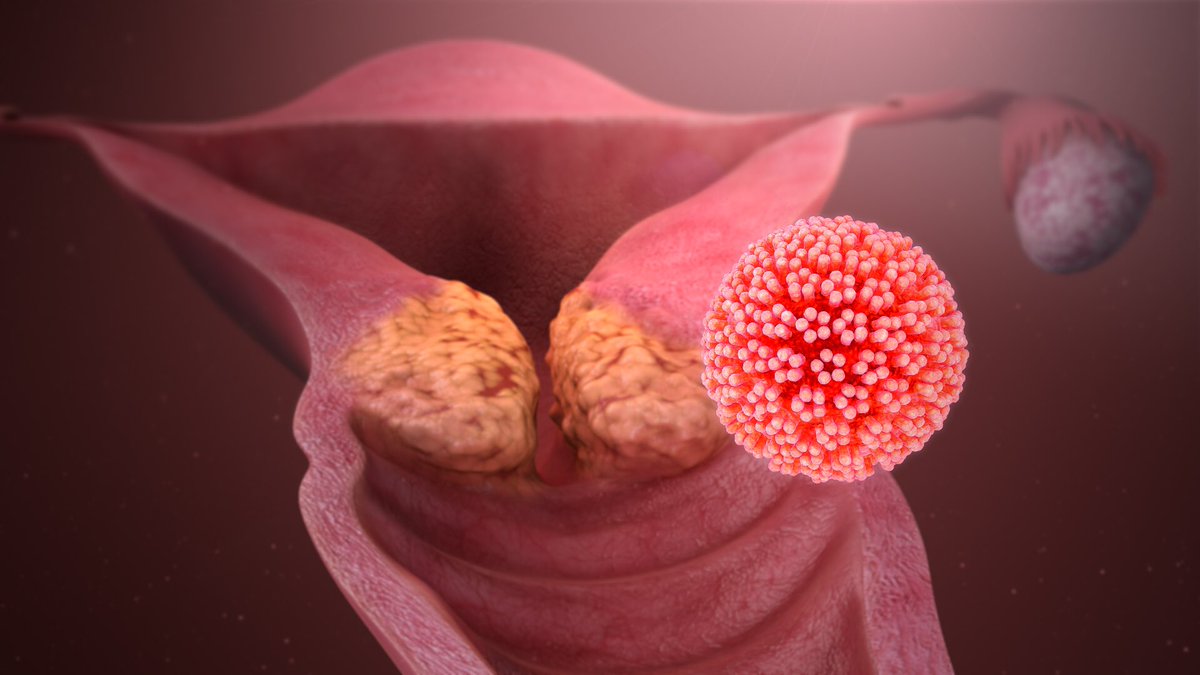 Cervical cancer is caused by specific strains of the Human Papilloma Virus (HPV) which grows just in the opening of the cervix and causes abnormal cells to start growing.