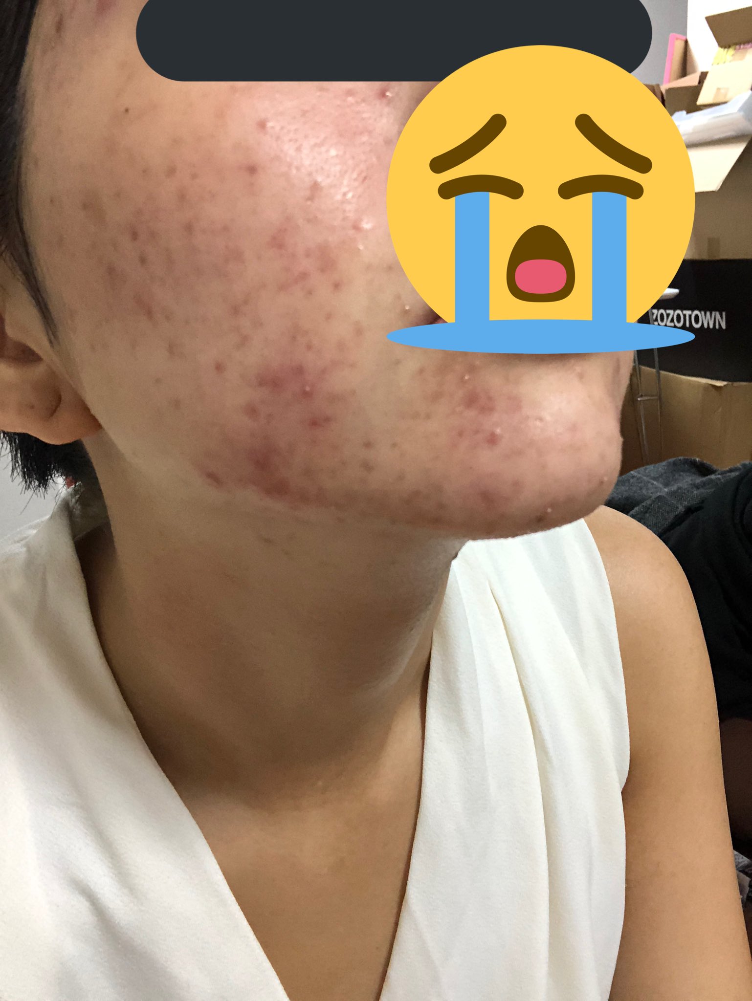 うさたにパイセン 初書籍販売中 肌の調子を見たいというコメントが多かったので ピーク時より目にわかる改善とツヤ感が まだまだ元どおりにはならないけどやっとスッピンでも家から出れるほどになってきたので肌荒れで悩んでいる方々 諦め