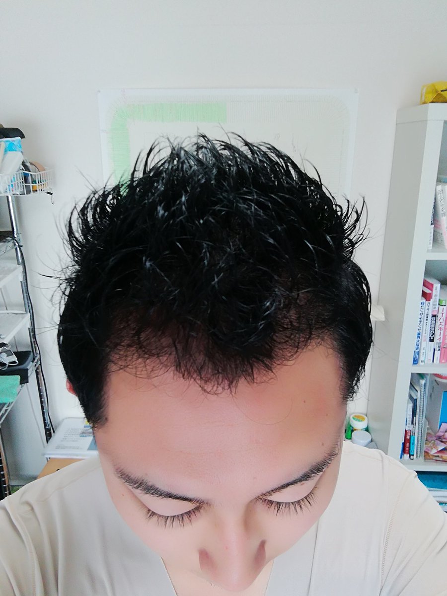 ハゲリーマンちゃんねる 毛髪診断士 ハゲ対策系youtuber على تويتر 18年5月 中国でm字部分に植毛して来ました 5ヶ月の髪型です 5ヶ月もするとジェル ワックス等でセットも可能です 美容室にも月1回通っています 経過観察 5ヶ月 スタイリング セット