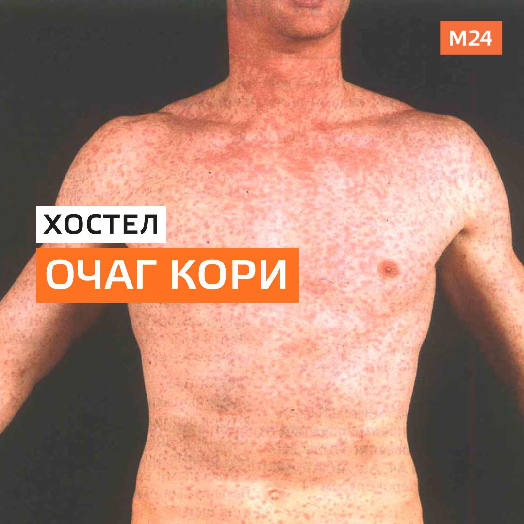 сыпь у детей при коронавирусе фото