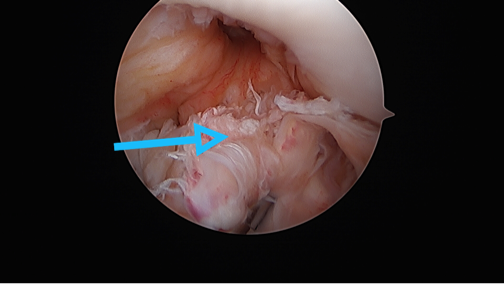 DrAlDeSimone's tweet photo. HOW CAN PRP BE BENEFICIAL IN ACL RECONSTRUCTIVE SURGERY?

Platelet-Rich Plasma (PRP) is a new technology focused on enhancing the healing response after a sports related injury. https://t.co/jEdn3vwHLt