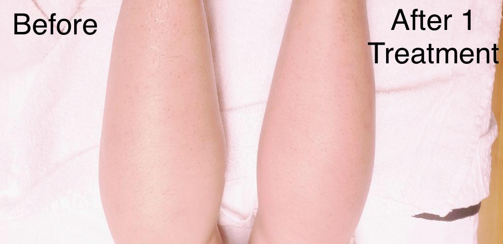 Restore303's tweet image. Now offered at Restorations, Viora Laser!  Skin Tightening, Laser Hair Removal, Laser Resurfacing, Acne Clearance and so much more!  Call (720)266-6029 for a free consult!  Each picture is only 1 treatment with Skin Tightening!  Can be used for the face, neck, stomach and more.