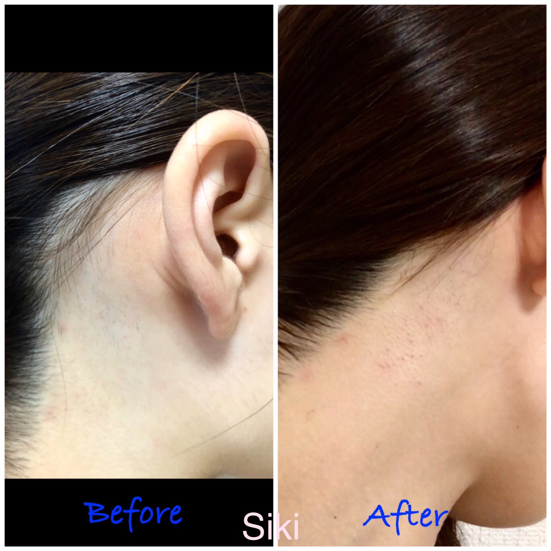 Siki V Twitter うなじ2回目 脱毛したあとに ポツポツの吹き出物が 更新したので 良かったら見てください 湘南美容外科のお友達紹介もしております ｰ T Co Kbw0eqeqva うなじ脱毛 脱毛 うなじ 医療脱毛 襟足脱毛 湘南美容外科