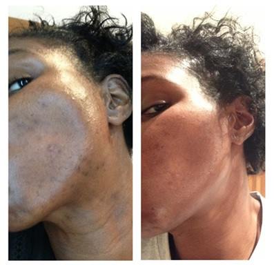 CorsilverUK's tweet photo. “To suffer with acne for most of my life and then find a product that actually works has been revolutionary!”
See how The Silver Soap worked for Rachel: https://t.co/JoegZEzGQl https://t.co/odBZaWr2Md
