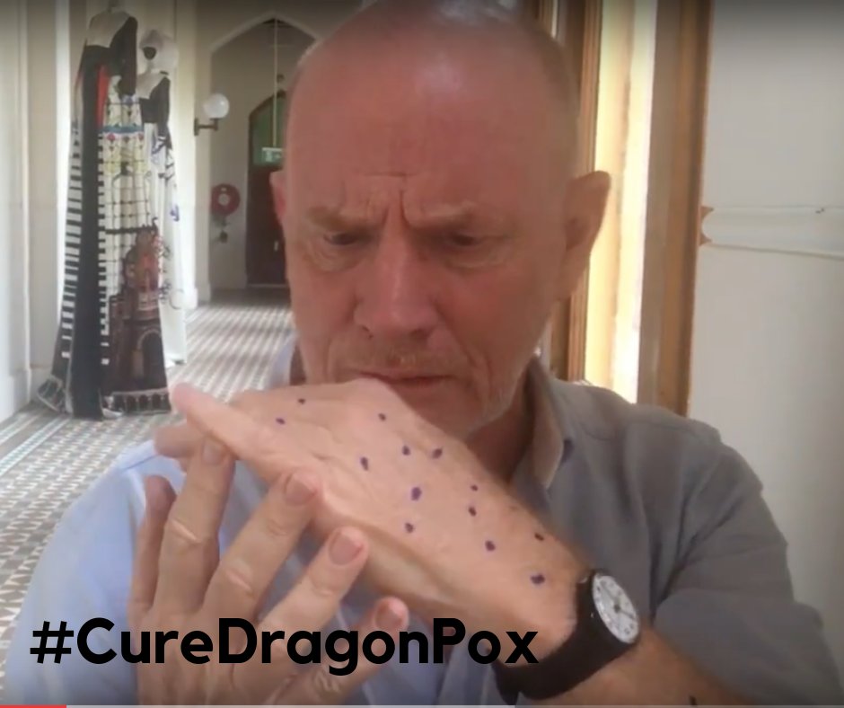 HealthMagical's tweet image. Bryan is distressed abut how mind-boggilingly fast dragonpox has devastated his life and his whole family have been affected. #CureDragonPox #OUDI19