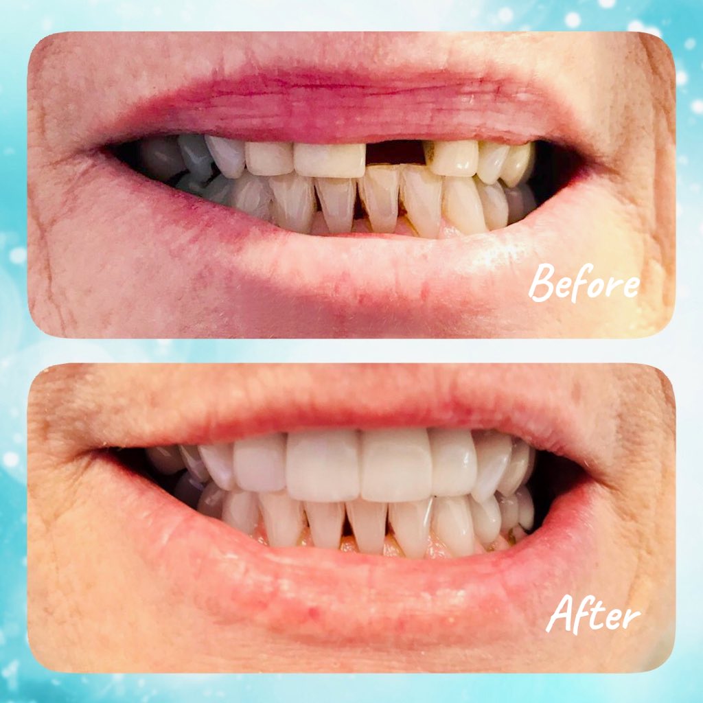 LevenshulmeDen2's tweet image. **Do you have an old crown or bridge that appears to be deteriorating? Would you like to replace a missing gap with natural looking teeth?**
#dentalcrown #dentalveneers #veneers #crowns #dentalbridges #dental #dentist #dentistry #levenshulme #didsbury #stockport #manchester