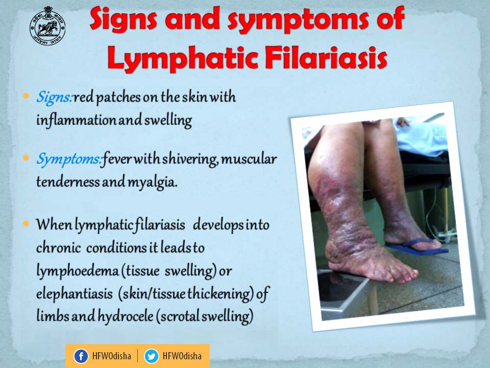 H & FW Dept Odisha on Twitter: "Know the symptoms of Lymphatic #Filariasis.  Report to your nearest sub centre, PHC, CHC or any government health  facility if you recognise any such sign. #