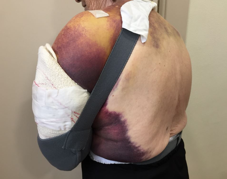 Resultado de imagen de hematoma hennequin