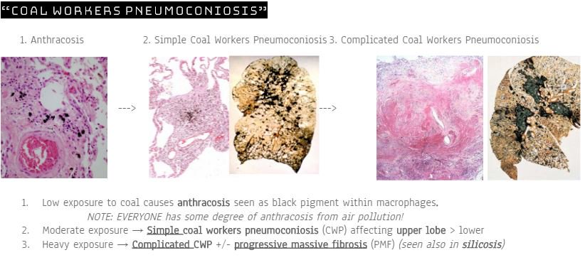 HeartPathology's tweet photo. Here is another grab-bag of pulmonary pathology. Should be posting the entire notes/study guide on my website soon enough. Enjoy :) 
#PathTweetAward #HYPath #Pathboards #IHeartPathology #Pulmpath https://t.co/3CBkLufxxU
