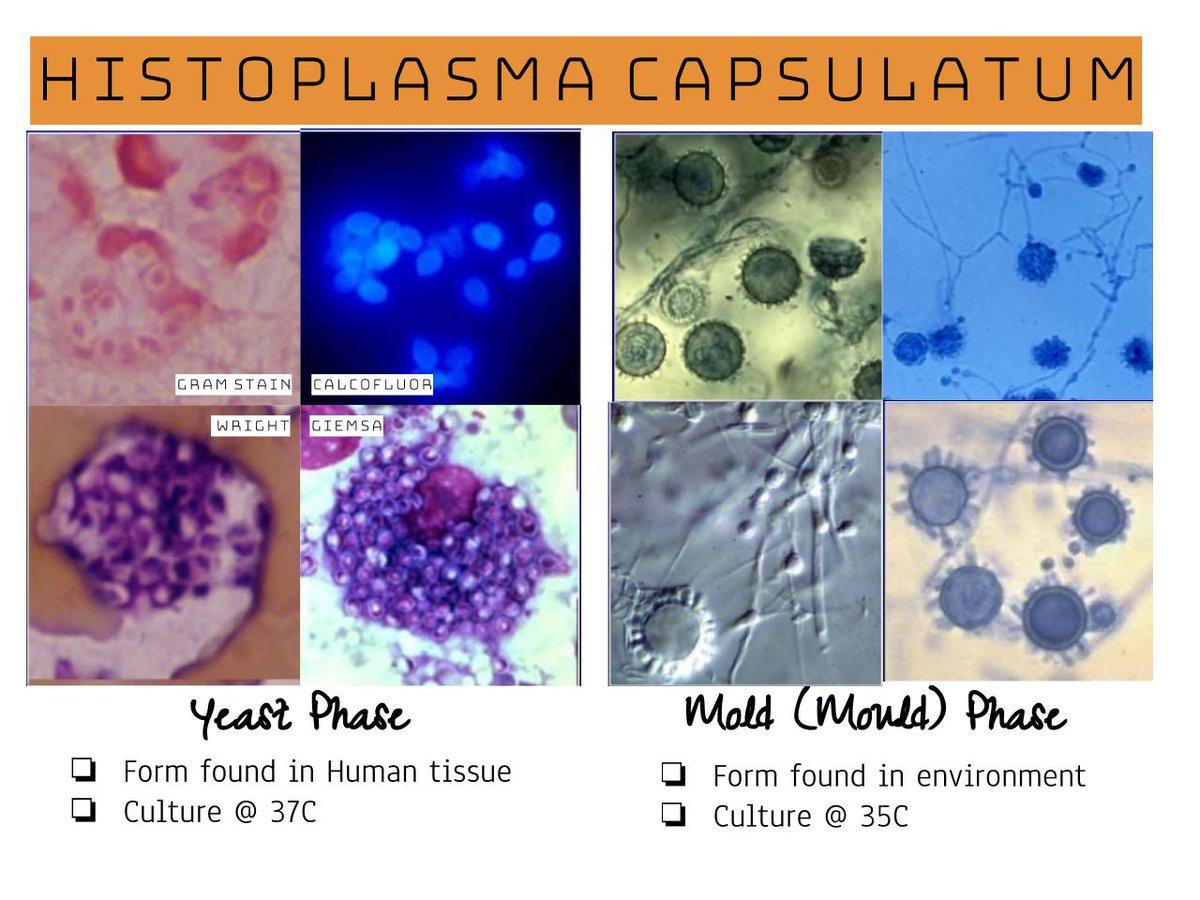 HeartPathology's tweet photo. Here is another grab-bag of pulmonary pathology. Should be posting the entire notes/study guide on my website soon enough. Enjoy :) 
#PathTweetAward #HYPath #Pathboards #IHeartPathology #Pulmpath https://t.co/3CBkLufxxU
