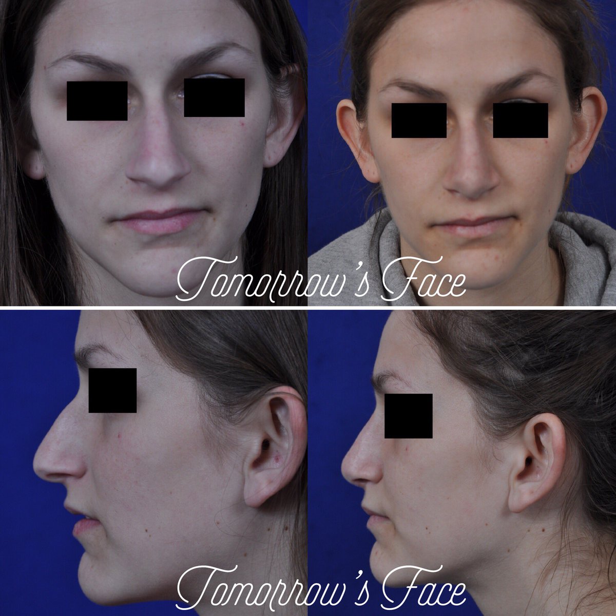TomorrowsFace's tweet photo. Dr. Morrow utilizes #ComputerImaging to assist in the development of a sound #SurgicalPlan based upon shared #aesthetic goals & #RealisticExpectations. He takes into consideration the patient’s #FacialShape as well. https://t.co/yTBcWLFHYR