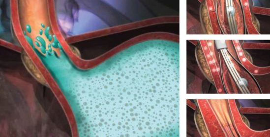 CJMStretta's tweet photo. "#STRETTA is the Least Invasive Method for #GORD" - Lessons Learnt about #GORD, STRETTA and Technical Considerations for @StrettaTherapy - a review by Professor Kenneth J Chang #Gastroenterology #UpperGI @Restech_LPR  https://t.co/qhHN59ofWv @cjmedicaluk https://t.co/V9ONliEsQi