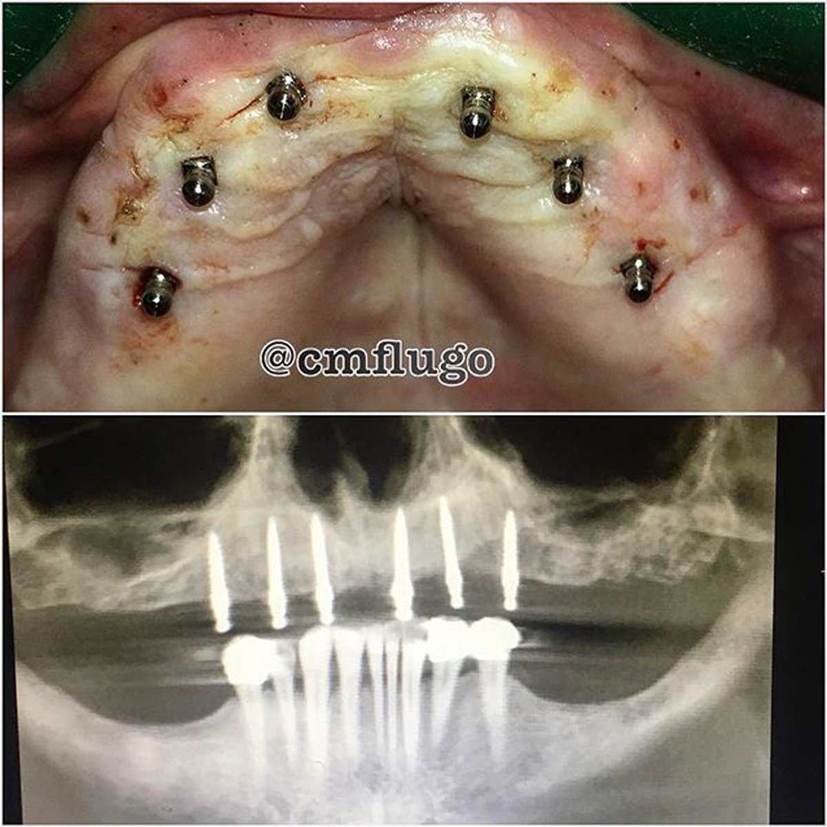Ask your dentist for the best solution according to your needs. 😉
➡ allon4cancun.com
#miniimplants #allon4 #cds #dromarlugo