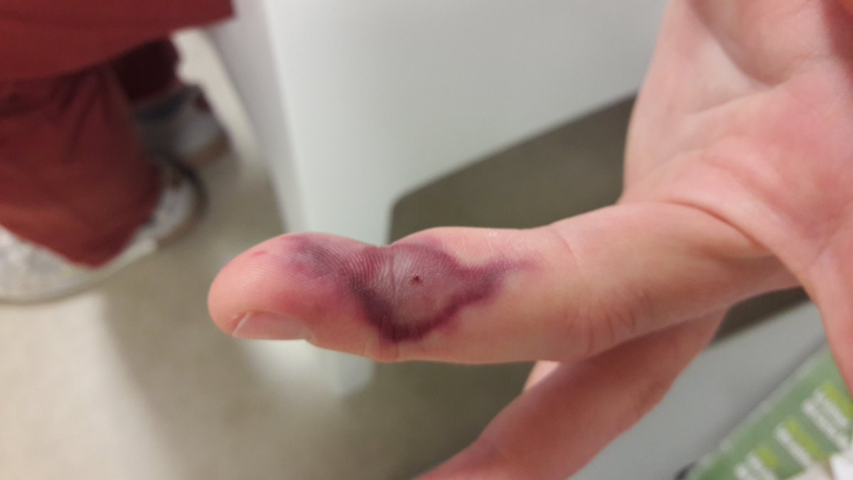 Safety first !!!
So here is a simple question tweeps.
Which solvent could have caused such injury after poking one's finger with a syringe and injecting 1-2 drops of solvent. 15 minutes and 2 hrs pictures