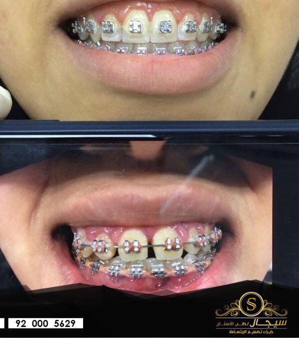 بعد مروور ٩ اشهر على علاج التقويم👍🏻
.
سيجال لطب وتجميل الأسنان عياده التقويم الدكتور منار 0582222283🔥
.
#صحتك_تهمنا #سيجال #سيجال_صناع_الإبتسامة 
#اسنان_بيضاء #الدمام #ابتسم #السعودية 
#أفضل_طبيب_تقويم_أسنان_في_الشرقية_د_منار
#ابتسامة_المشاهير #ابتسامة #تركيبات_الأسنان