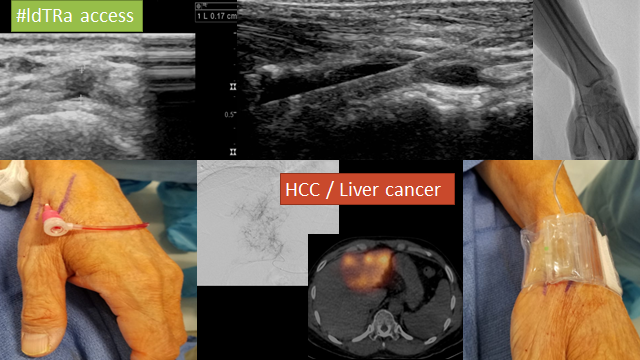 Keith Pereira MD, #VIrad tweet media