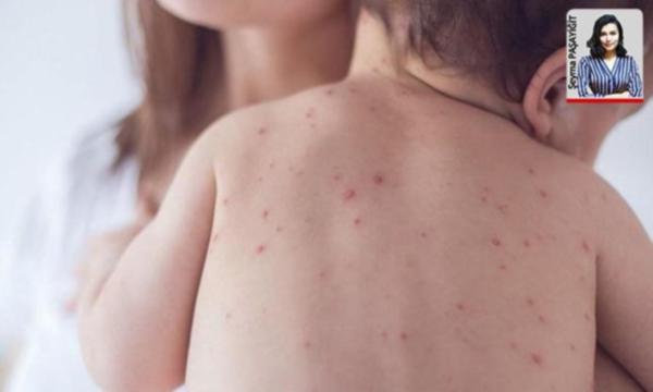 Bakan aşı yaptırmayanları uyardı: ‘Kızamıkta ciddi artış var’
cumhuriyet.com.tr/haber/saglik/1…