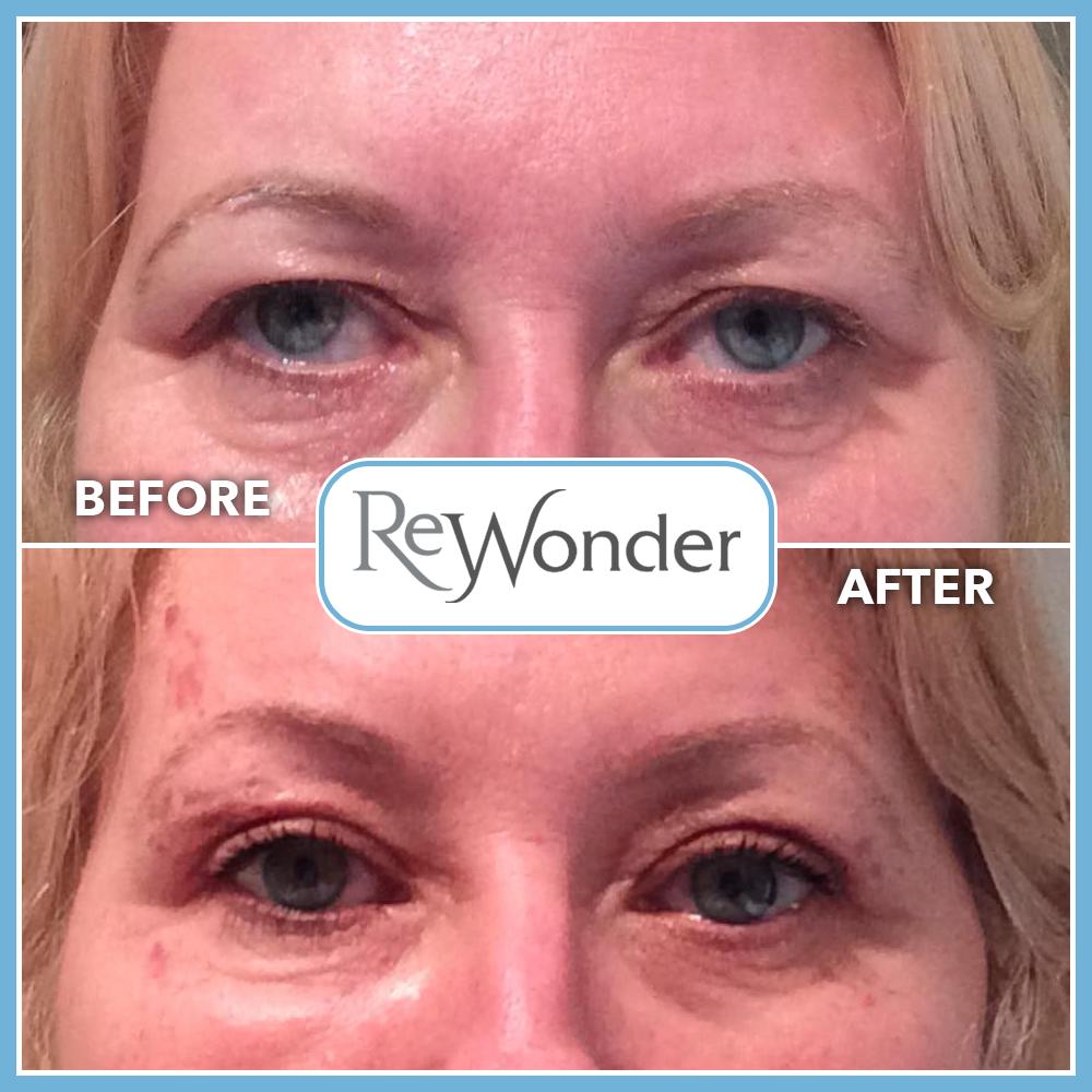 Wondertoots's tweet photo. Plasma IQ Blephroplasty treatment with only 3 hours between!

It is recommend to take a course of three treatments to achieve comparable results with eyelid surgery. 

01484 423023
https://t.co/d1JFlU3odO

#ReWonder #Wrinkle #Dermal #Fillers #Peels #Younger #Youthful #Eyelids https://t.co/UgJGy89zpR