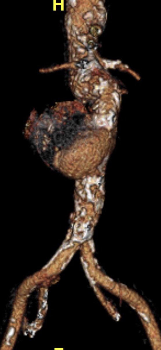 DrAliAzizzadeh's tweet photo. #endovascular repair of #saccular #abdominal #aortic #aneurysm #AAA narrow bifurcation using a tube graft #VascularSurgery #VascularHealth @CedarsSinai https://t.co/3x9ingV2WT