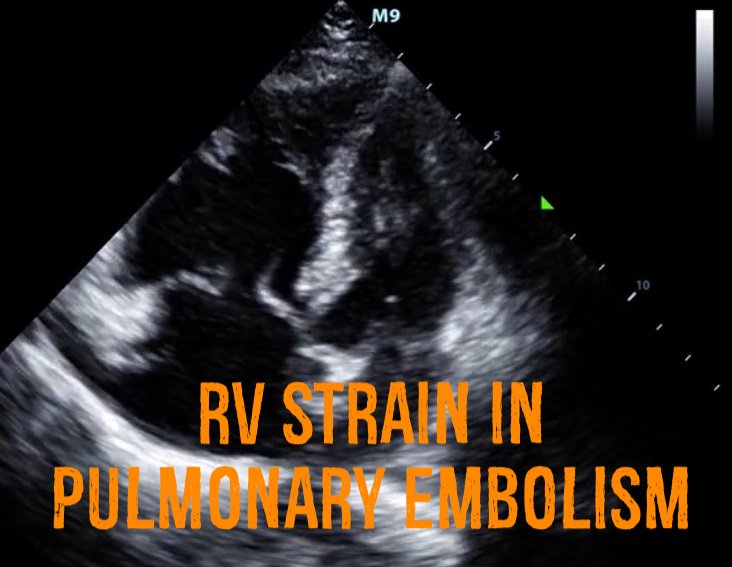 New post! Right Ventricular Strain in Pulmonary Embolism...