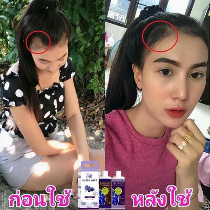 qherb_shop's tweet photo. เส้นผมหนาขึ้น รากผมแข็งแรง ดกดำ 
ไรผมอ่อนๆขึ้นอีกเพียบ กระตุ้นรากผมให้งอกใหม่ 
ยับยั้งผมหงอก 98% เห็นผลตั้งแต่ชุดแรก
ผมร่วงลดลงชัดเจน แถมเร่งผมยาว2-3cm ใน1เดือน https://t.co/ArmHTwhEYK