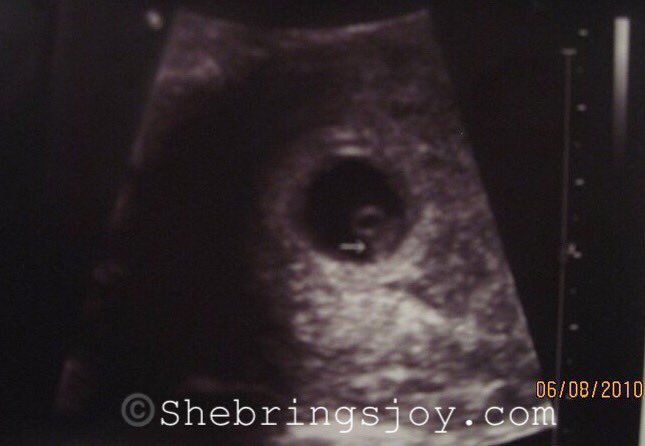 shebringsjoy's tweet photo. #StillMe #StillBea #IncompatibleWithLife #CompatibleWithLove #ProLife #LateTermAbortions #Personhood #PoorPregnancyDiagnosis #FatalFetalAnomaly #FatalFoetalAnomaly #LifeLimitingCondition #TreatmentNotTermination
To learn more see:
@SaveThe1Child @Simons_Law @trisomy13patau ❤️ https://t.co/4jcdy9xDTx