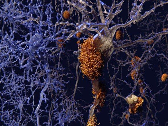 sciam's tweet photo. The unsettling evidence that Alzheimer’s Disease may be transmissible under limited—but definitely nonzero—circumstances keeps growing. https://t.co/0TEvNRdHwa (By @JenniferFrazer) https://t.co/EZQr8ZnMl2