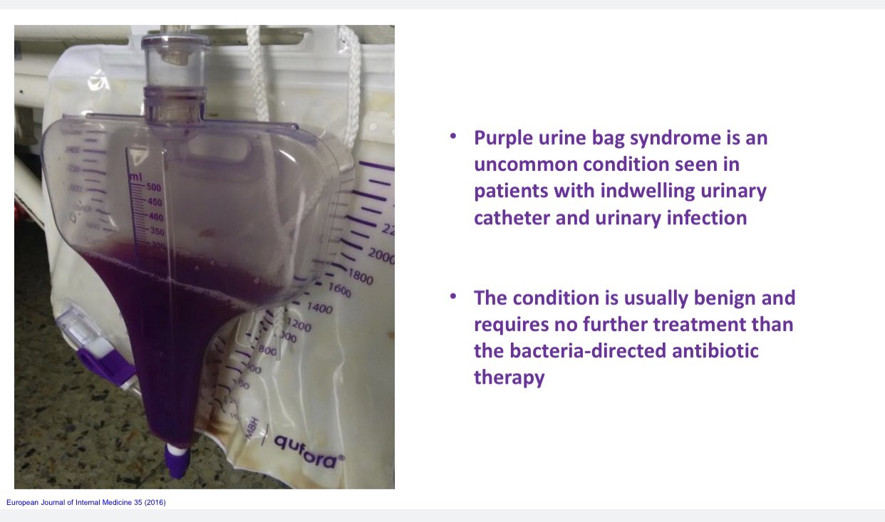 Discover 71+ purple urine bag syndrome stylex.vn