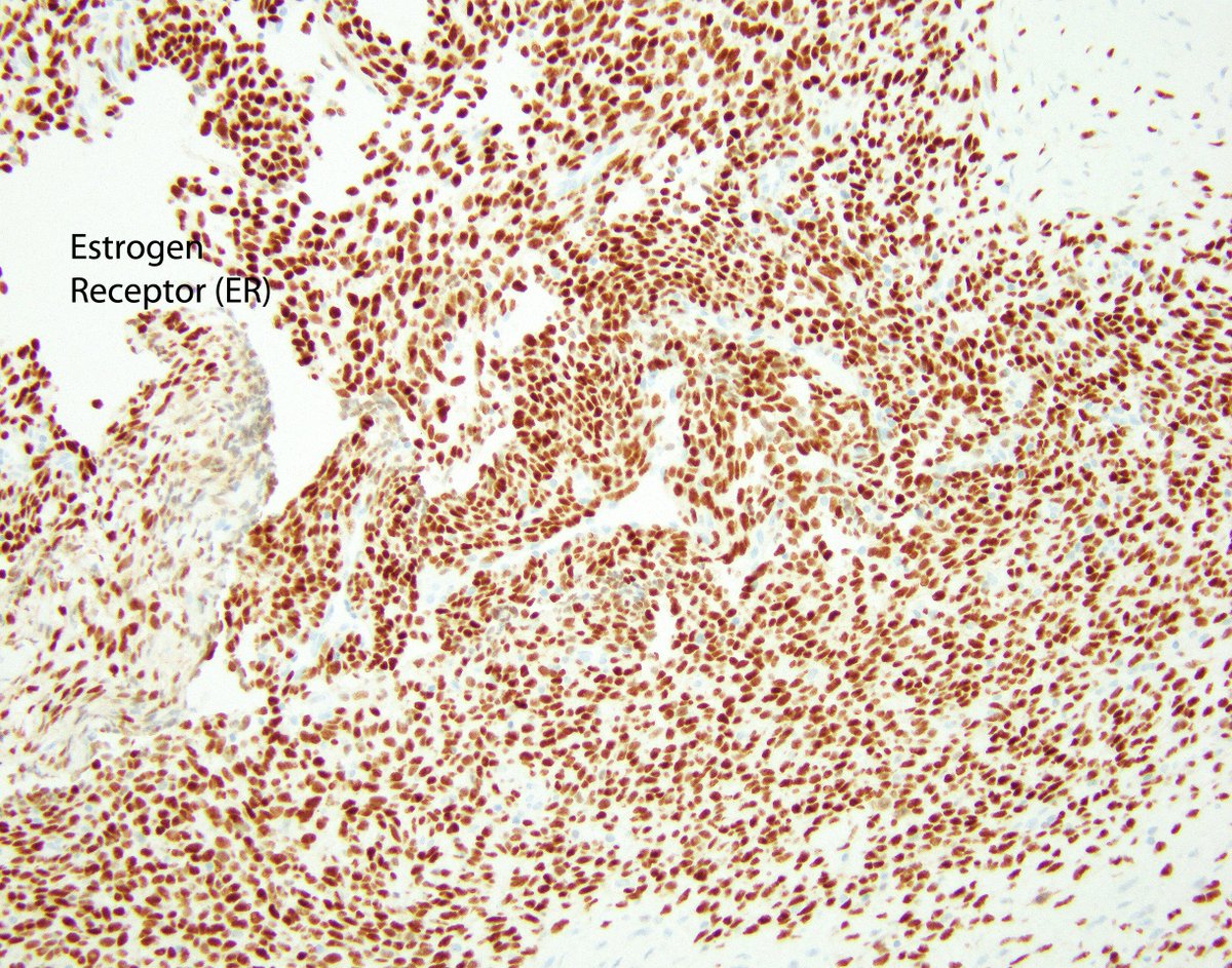 LizMontgomeryMD's tweet photo. Extra-uterine endometrial stromal sarcoma has a knack for mimicking synovial sarcoma.  The staghorn vessels and overlapping nuclei always send me down the wrong path at first but the collagen saves the day!  Yay - Phew. https://t.co/16Iuin5lqc