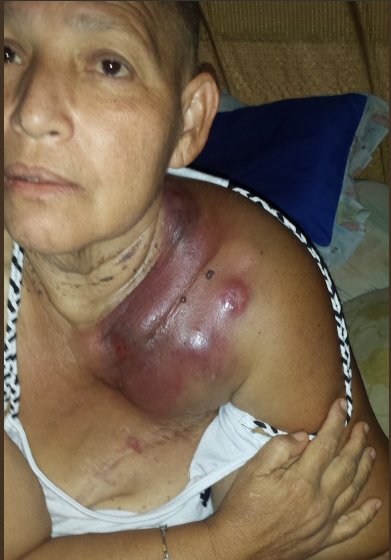 Rosilmu70's tweet photo. AYUDA URGENTE POR FAVOR. Para Belkis Gonzalez, paciente oncologico de cancer de mama, pedimos ayuda para su tratamiento y medicamentos. Ella es de Cd. Bolivar. Esperando que lleguen las medicinas por parte del gobierno cada dia esta peor. Graficamente mostramos su condicion. https://t.co/yZF5hPtIGQ