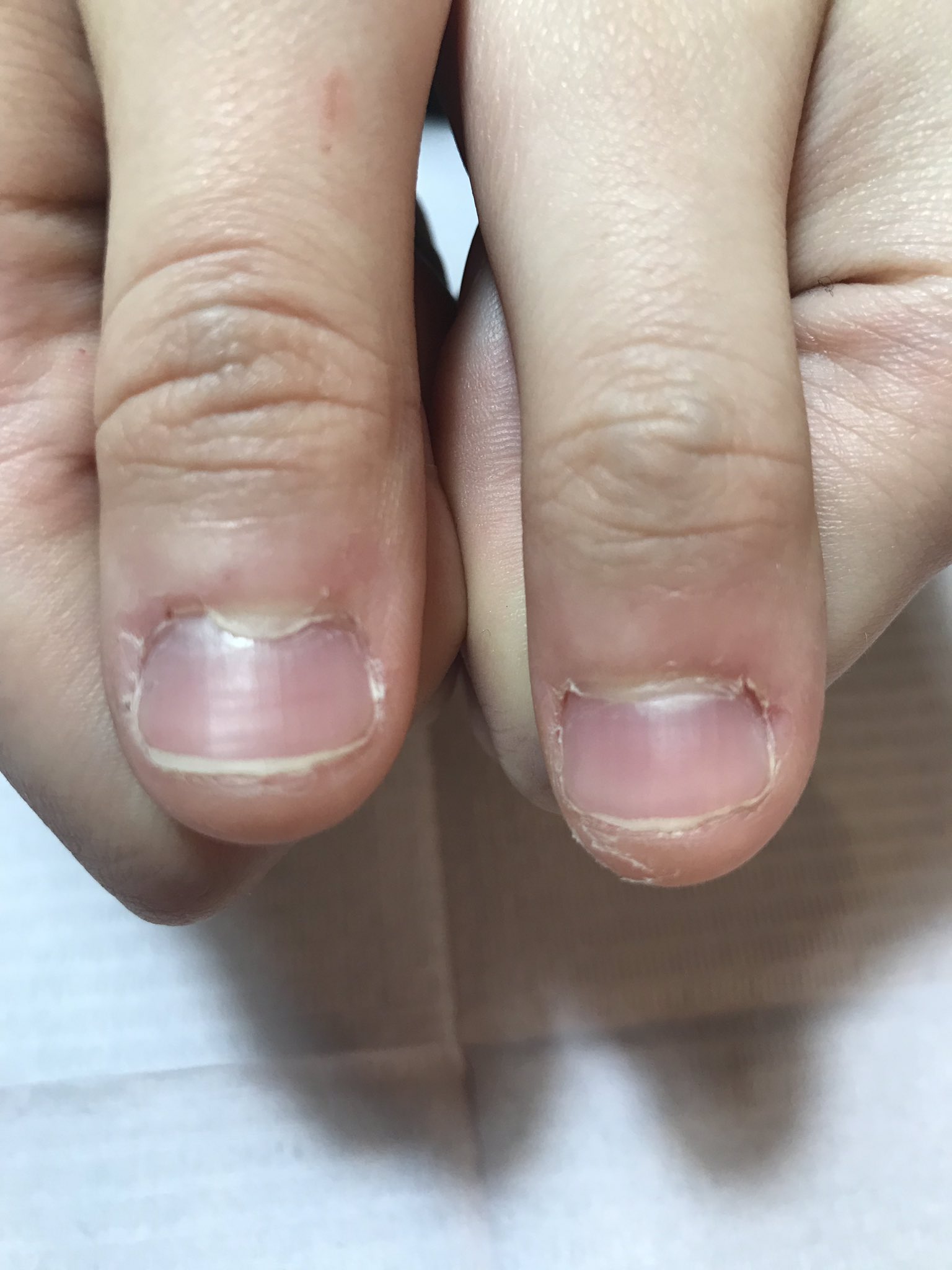 みんこ 吉祥寺 中野ネイルサロン 美爪屋mincono これは嬉しかったなぁ 3週間頑張ってくれました 施術後 二人でニヤニヤしました アクアジェルネイル 炭酸バブルトリートメント ハンドケア 爪噛み 育爪 深爪 爪 育成サロン吉祥寺