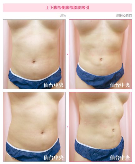 下腹部脂肪吸引