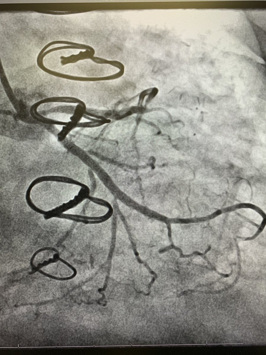 SidakpalP's tweet image. Final result, #completerevasc #leavenobranchbehind in #CTO