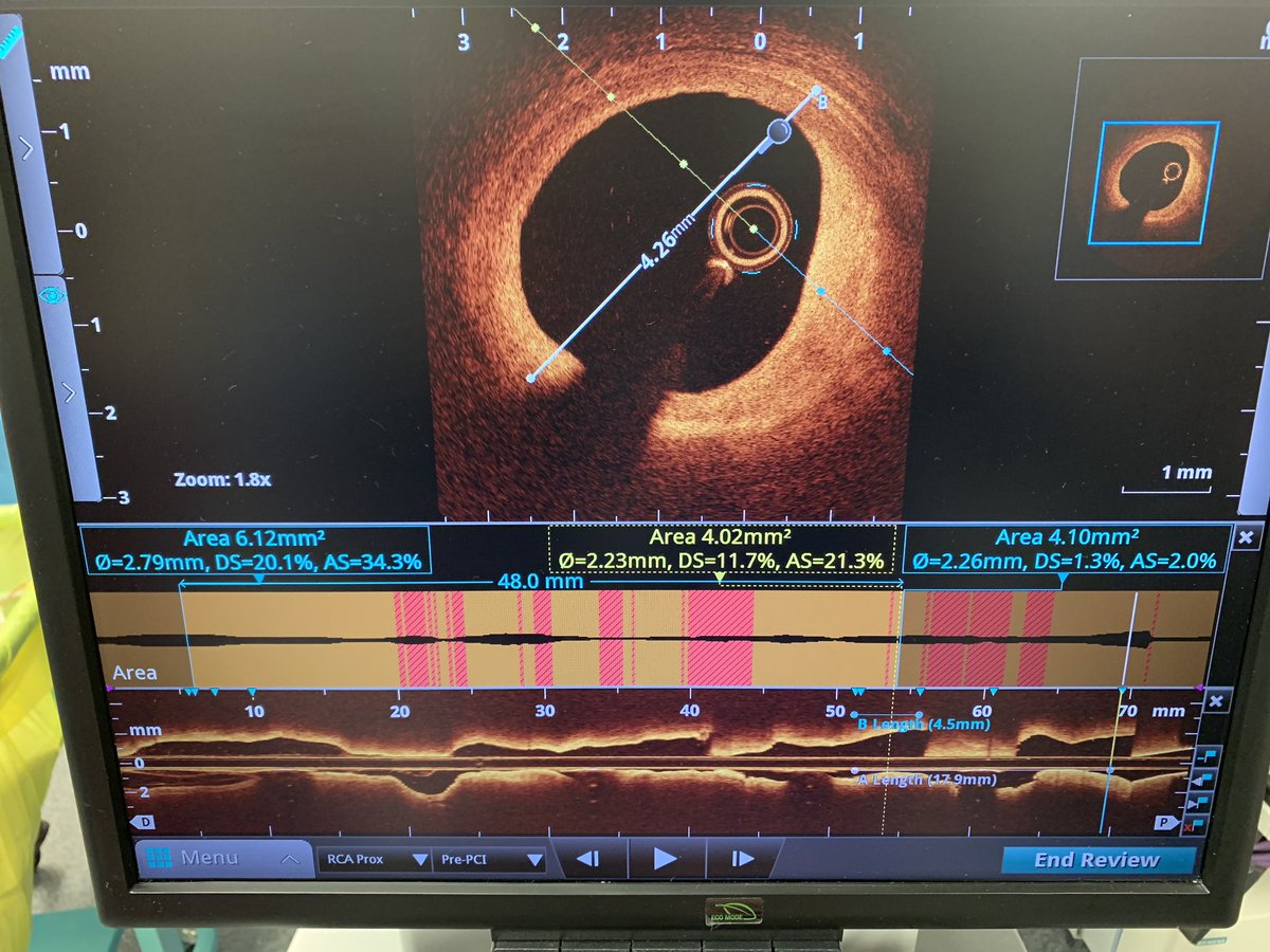 Mamas A. Mamas (@mmamas1973) on Twitter photo 1. #WhyOCT inf STEMI, unclear distal vessel size. Eyeball around 3mm. OCT 3.5mm distally, 4mm prox, >50mm stent..see nxt tweet. <a href="/AntoniousAttall/">Antonious Attallah, MD, FACC, FSCAI</a> <a href="/adityadoc1/">Aditya Bharadwaj</a> <a href="/SVRaoMD/">Sunil V. Rao</a> <a href="/EmileMehanna/">Emile Mehanna</a> <a href="/RezaEmaminia/">Abbas (Reza) Emaminia</a> <a href="/RodrigoBagur/">Rodrigo Bagur 🇦🇷🇨🇦</a> <a href="/oriolrodriguez5/">Oriol Rodriguez</a> <a href="/Costa_F_8/">Francesco Costa</a> <a href="/sbrugaletta/">Salvatore Brugaletta</a> <a href="/drandrewsharp/">Andrew SP Sharp</a> <a href="/heartdoc45/">David Homan, MD</a> 1. #WhyOCT inf STEMI, unclear distal vessel size. Eyeball around 3mm. OCT 3.5mm distally, 4mm prox, >50mm stent..see nxt tweet. <a href="/AntoniousAttall/">Antonious Attallah, MD, FACC, FSCAI</a> <a href="/adityadoc1/">Aditya Bharadwaj</a> <a href="/SVRaoMD/">Sunil V. Rao</a> <a href="/EmileMehanna/">Emile Mehanna</a> <a href="/RezaEmaminia/">Abbas (Reza) Emaminia</a> <a href="/RodrigoBagur/">Rodrigo Bagur 🇦🇷🇨🇦</a> <a href="/oriolrodriguez5/">Oriol Rodriguez</a> <a href="/Costa_F_8/">Francesco Costa</a> <a href="/sbrugaletta/">Salvatore Brugaletta</a> <a href="/drandrewsharp/">Andrew SP Sharp</a> <a href="/heartdoc45/">David Homan, MD</a>