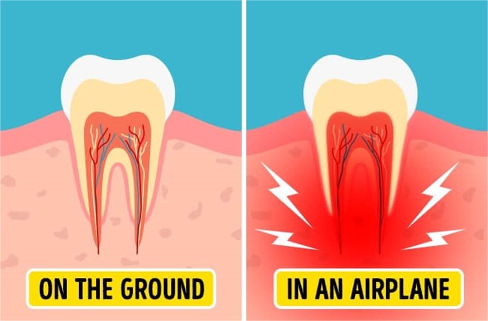 Barodontalgia, also known as tooth squeeze or aerodontalgia, is severe toothache caused by change in ambient pressure when flying on a plane or scuba diving 24houremergencydentistlondon.com/blog/barodonta…