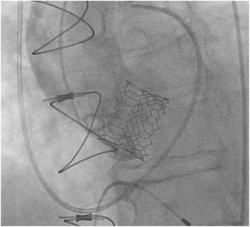 Successful #TranscatheterAorticValveReplacement in an #Oversized 800 mm2 #Annulus and #BicuspidAorticValve by Kyle D. Buchanan, Toby Rogers, @ShultsChristian, Itsik Ben-Dor, Lowell F. Satler and @ron_waksman in #casereports supplement bit.ly/2IdT7Wh