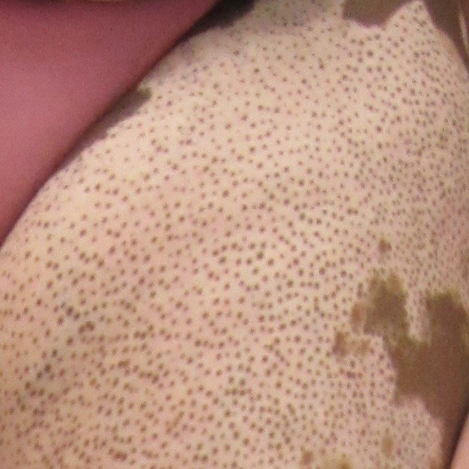 ClinuvelNews's tweet image. “Clinical response comes in the form of follicular #repigmentation – “islands” of colour returning to the skin of vitiliginous lesions around the hair follicle”. Learn more about narrowband UVB in CLINUVEL’s latest #Vitiligo Communiqué: zurl.co/OezJ