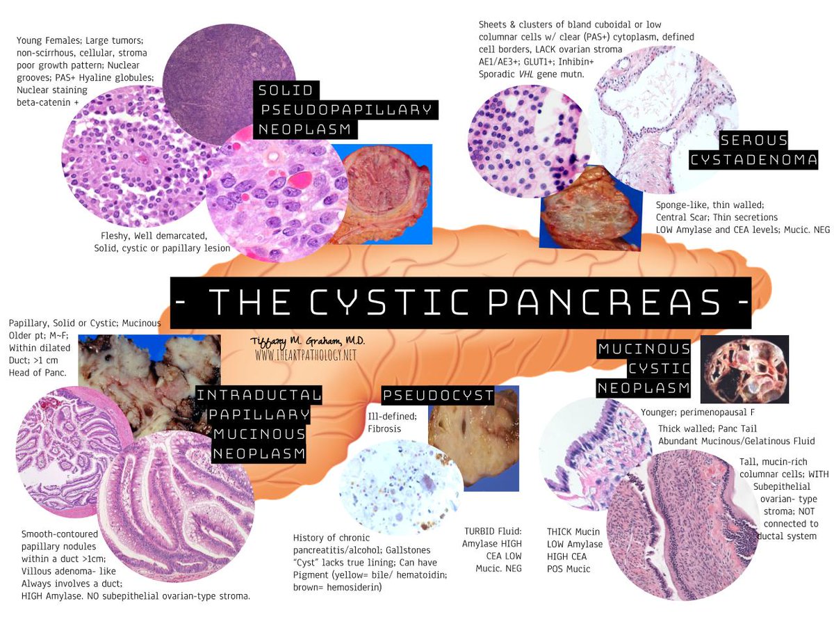 HeartPathology's tweet photo. Continuing on with summary charts... Solid, Non-Scirrhous Pancreatic tumors: Neuroendocrine tumors, Solid Pseudopapillary Neoplasm, Pancreatoblastoma, Acinar Cell Carcinoma (and Metastases) https://t.co/QBkpyVVzsX  
#PathTweetAward #PathBoards #HYPath #IHeartPathology https://t.co/OnJ2SaaSuc