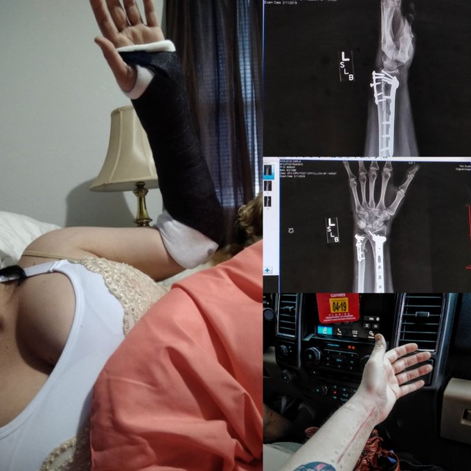 Got my hard cast on my arm yesterday. Still wearing a removable one, though. I will need surgery to remove<a href="/tag/mondaymotivation"class="tags"><span>#mondaymotivation</span></a><a href="/tag/boobs"class="tags"><span>#boobs</span></a><a href="/tag/haveagreatday"class="tags"><span>#haveagreatday</span></a>