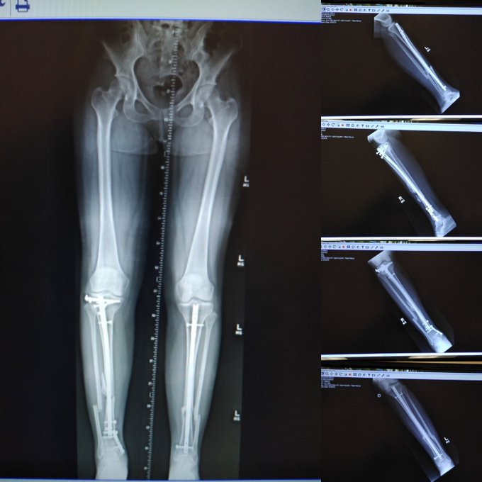 Here's my legs x-ray view. The right one is the leg that I'm going to have reconstructed. https://t.<a href="/tag/anal"class="tags"><span>#anal</span></a><a href="/tag/nsfw"class="tags"><span>#nsfw</span></a><a href="/tag/slutty"class="tags"><span>#slutty</span></a>