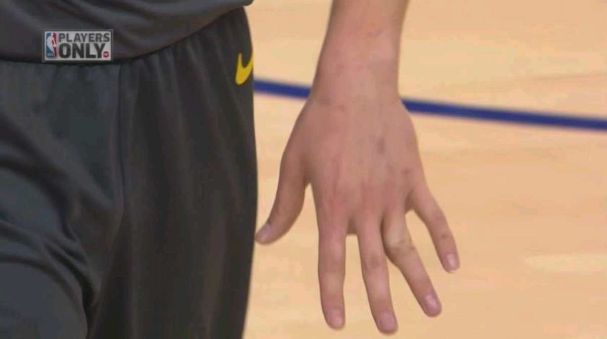 Волейбол пальцем игра. Пальцы баскетболистов. Травма пальца в баскетболе. Травмы пальцев рук в баскетболе. Травмы в волейболе.