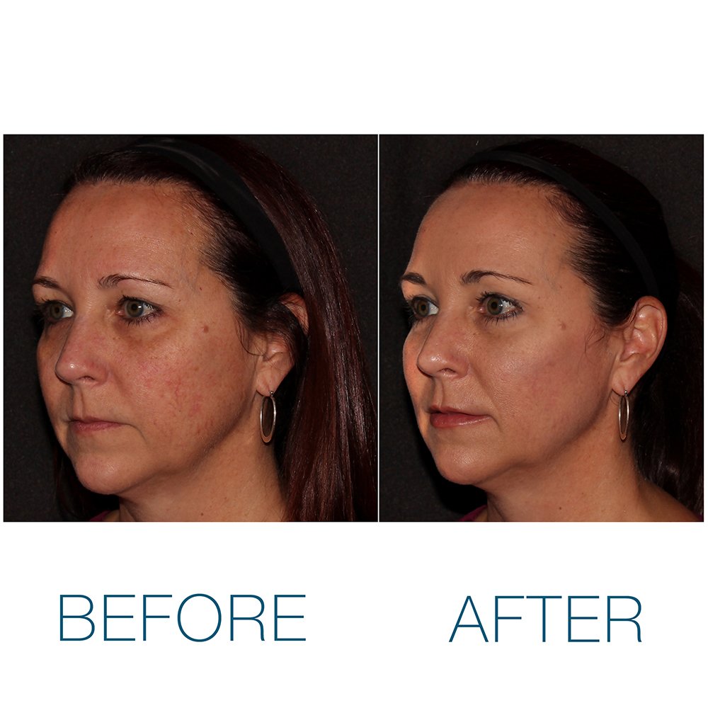 DrHeidiAnderson's tweet photo. We used fillers on this patient to help her achieve a more lifted, youthful appearance. Dermal fillers offer a quick and easy way to take years off the face and correct volume loss. #fillers #COSMETICS https://t.co/PbqwE8eq80