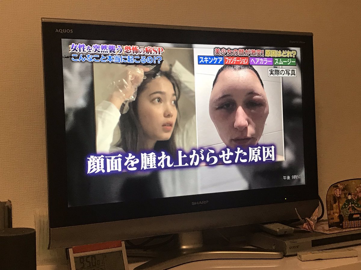 candypop0124's tweet image. 最近なのテレビは大丈夫か？
ヘアカラーのアレルギーで顔が腫れた女性の話、昨日仰天ニュースでやってたよね？
マサカの映像グランプリでマサカのネタ被りwww
#世界仰天ニュース #マサカの映像グランプリ